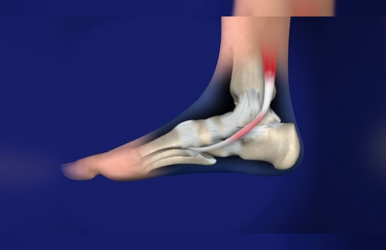 posterior-tibial-tendon-disfonksiyonu